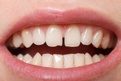 Diastema between the upper incisors is a normal feature