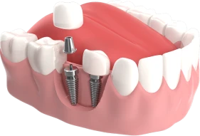 Smile Dental Clinic Muscat dental care